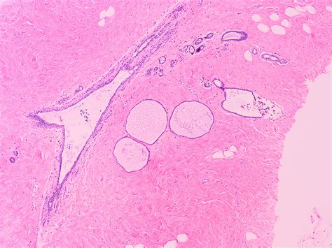 Pathology Outlines - Nonproliferative fibrocystic changes