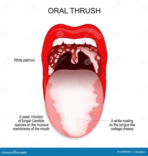 Oral Thrush. a White Coating on the Tongue and White Patches in Throat Stock Vector ...