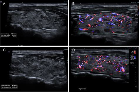 Graves Thyrotoxicosis Icd 10 at Joyce Priddy blog
