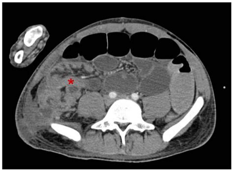 Postoperative Intestinal Intussusception in Polytraumatized Adult ...