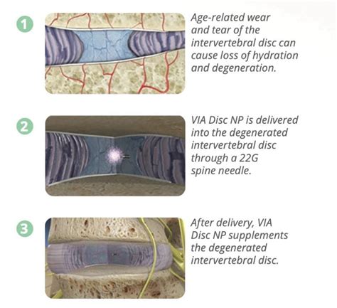 Image result for Via Disc Procedure