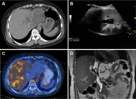 Hepatobiliary diseases - European Journal of Internal Medicine