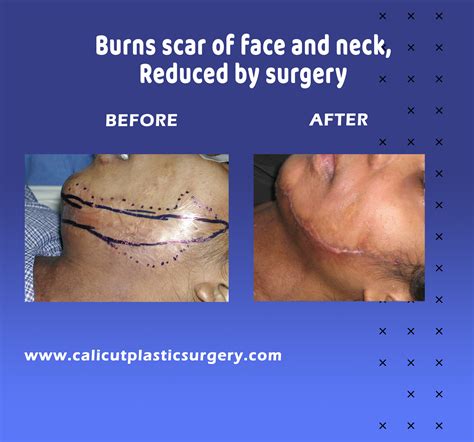 Face Burn Scar
