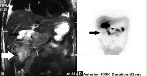 Image result for Hida Scan Explained