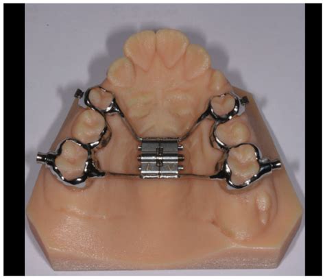 Association between Rapid Maxillary Expansion and Nocturnal Enuresis in ...