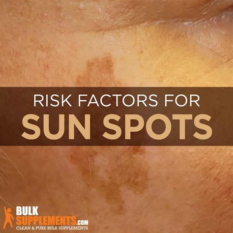 What are Sunspots: Symptoms, Causes & Treatment