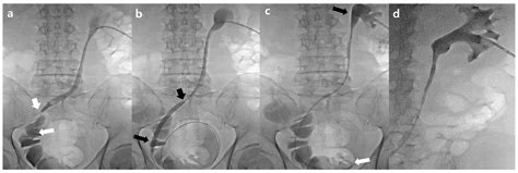 Percutaneous Ureteral Stent Insertion in Patients with Benign Uretero-Ileal Anastomosis ...