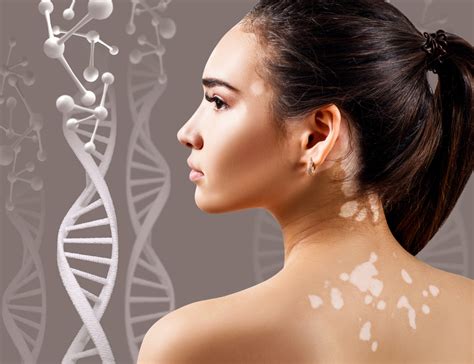 What is Vitiligo? | Causes, Signs, Symptoms, & More | Vitiligo Society