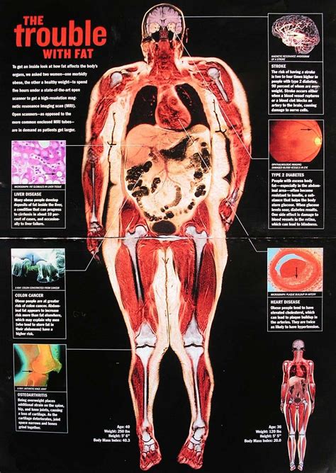 Fat Person Body X Ray at Zoe Oatley blog