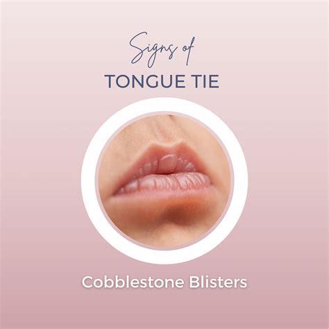 Milk Blister Baby Lip