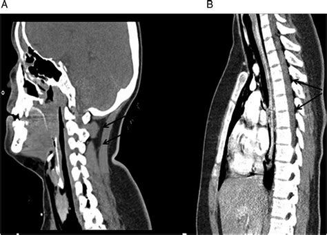 Epidural pneumatosis associated with spontaneous pneumomediastinum: a rare complication of ...