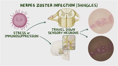 Herpes zoster infection (shingles): Clinical sciences - Osmosis Video Library