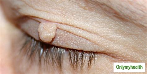 Visible Bumps On The Skin? These Bumps Can Be Dermatofibromas, Says Dr ...