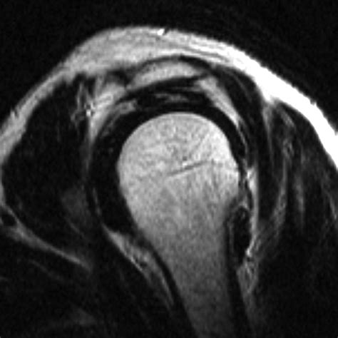 Acromion Types Mri