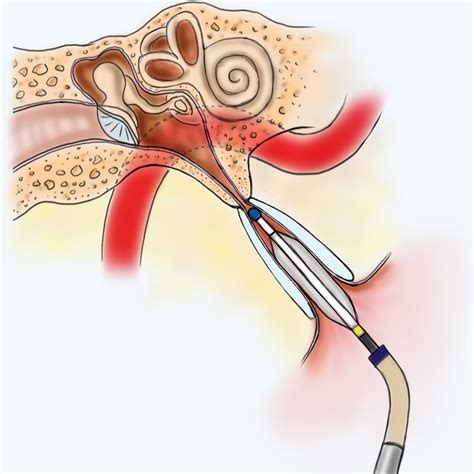 Eustachian Tube Dysfunction - Easmed