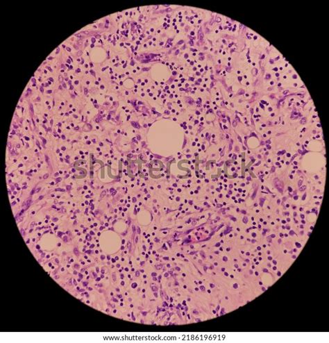 Image result for Axillary Abscess