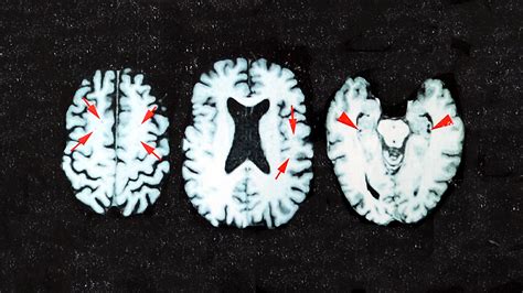 CTE Brain 的图像结果