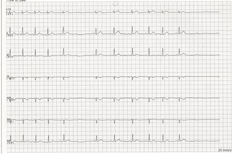 Second degree heart block type II