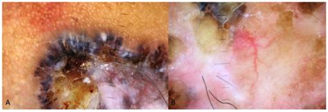 Clinical and Dermoscopic Patterns of Basal Cell Carcinoma and Its ...