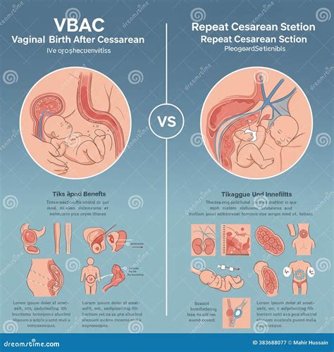 Infographic Comparing VBAC (Vaginal Birth After Cesarean) And Repeat ...