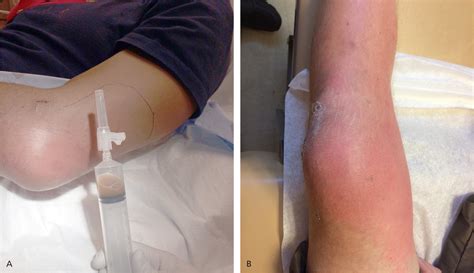 Septic Bursitis Knee Treatment at Lara Caley blog