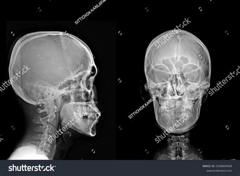 X Ray Anatomy