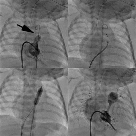 Cardiac Catheterization Right Heart