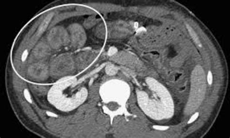 Free fluid on CT, acceptable indicator for surgery in traumatic bowel ...