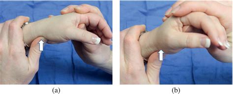 Scaphoid Fracture Test 的图像结果