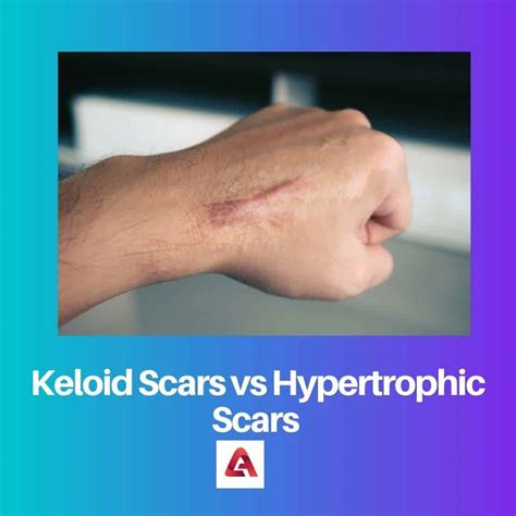 Keloid vs Hypertrophic Scars: Difference and Comparison