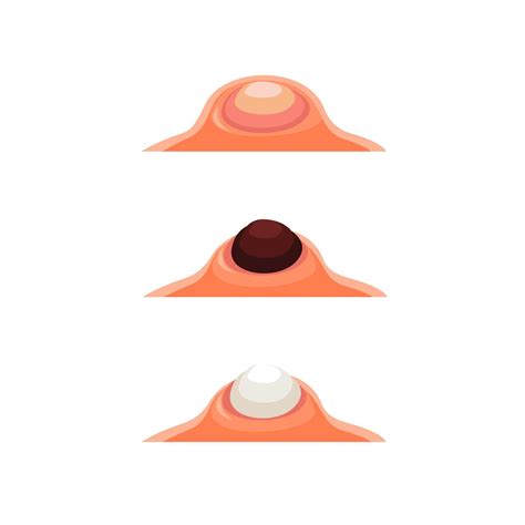 Comedo, Pimple and blackhead dermatology health symbol set vector 9841328 Vector Art at Vecteezy