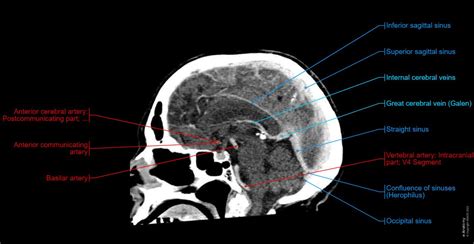 Image result for Normal Brain CT Scan