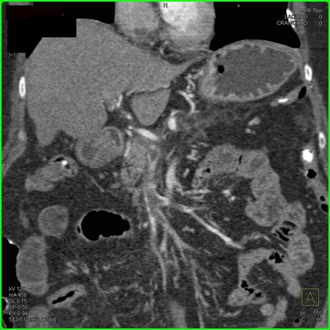 Portal Vein and Superior Mesenteric Vein (SMV) Thrombosis - Vascular Radiology Case Studies ...