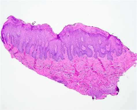 Pathology Outlines - Proliferative verrucous leukoplakia (PVL)