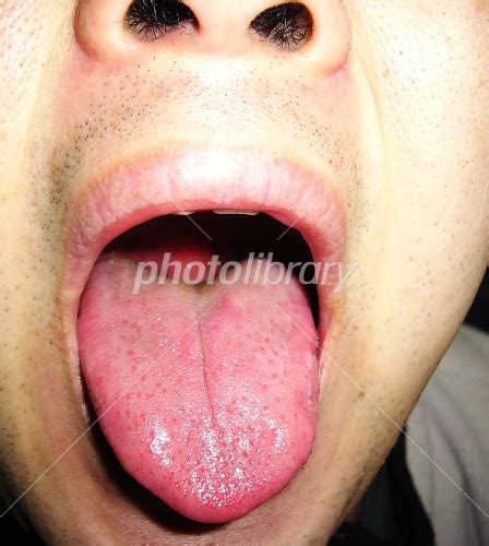 舌炎 写真素材 [ 1942589 ] - フォトライブラリー photolibrary