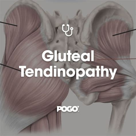 Best 13 Diagnosing gluteal tendinopathy in clinical practice – Artofit