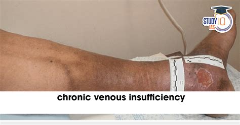 Chronic Venous Insufficiency: Symptoms, Risks and Treatment