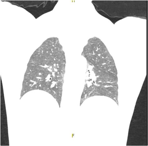 Image result for Normal Profile CT