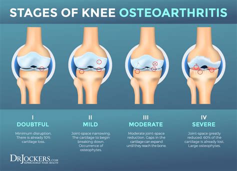 Osteoarthritis: Symptoms, Causes and Natural Support Strategies