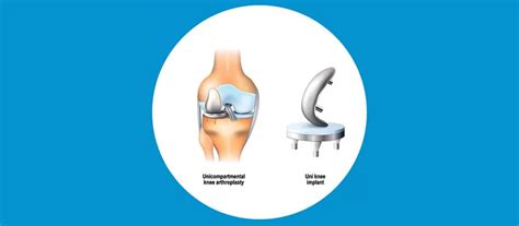 Best Surgeon For Unicondylar Partial Knee Replacement In Mumbai , Dadar ...