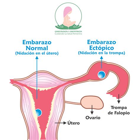 Embarazo Ectópico: Definición, Clasificación Y Factores De Riesgo – OFNW