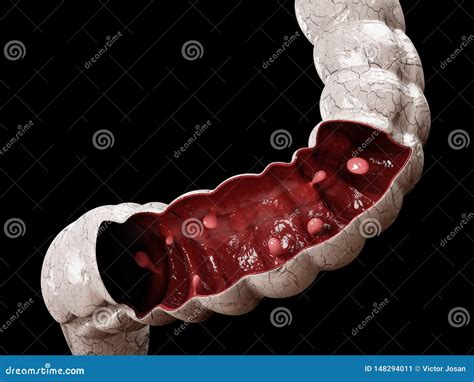 Colon Polyps. 3d Illustration, Polyp in the Intestine. Stock Illustration - Illustration of ...