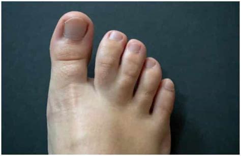 Unraveling the Enigma: Unveiling the Rarity of Webbed Toes