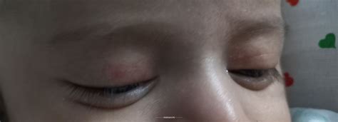 Ask a Eye Specialist Online for Swelling Under Eyes