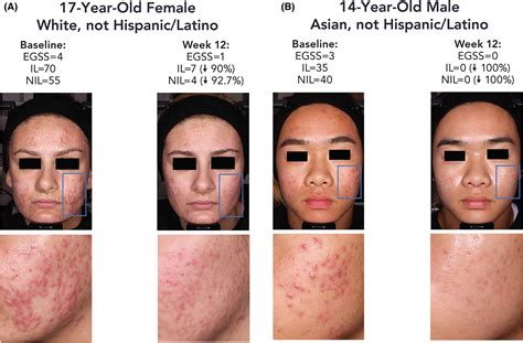 Triple‐combination clindamycin phosphate 1.2%/benzoyl peroxide 3.1%/adapalene 0.15% gel for ...