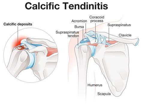 Calcific Tendinitis of the Shoulder | Complete Physio