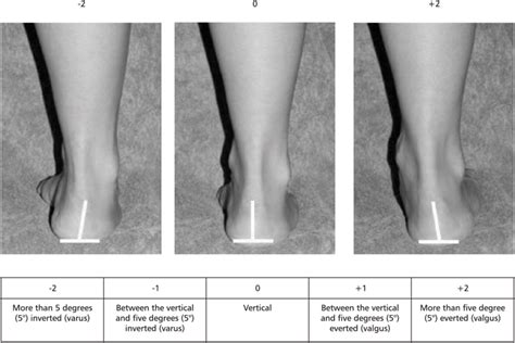 Intrarater reliability of the Foot Posture Index (FPI-6) applied as a ...