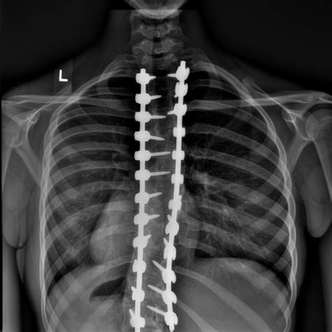 Understanding Scoliosis Surgery – ScoliCare