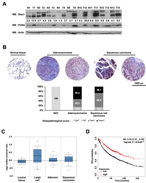 High Level of Staufen1 Expression Confers Longer Recurrence Free ...