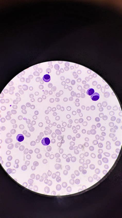 Plasma cell Leukaemia : r/Hematology
